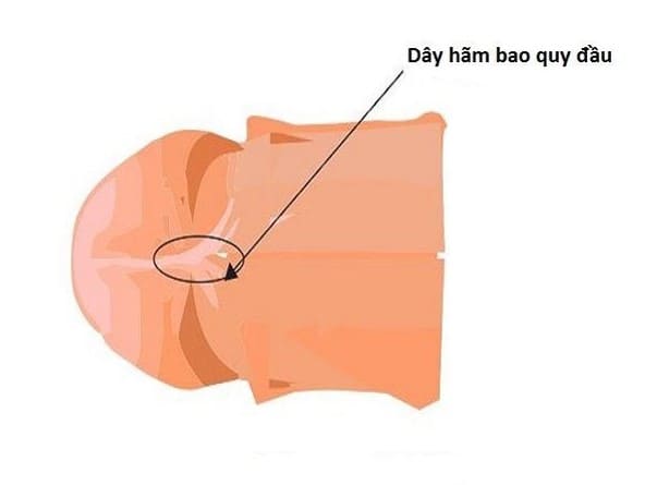 Rách dây hãm bao quy đầu