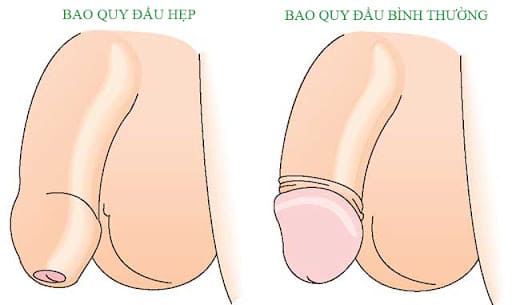 Hẹp bao quy đầu