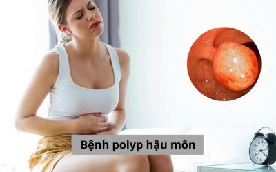 Bệnh polyp hậu môn là gì? Có nguy hiểm không? [Giải đáp]