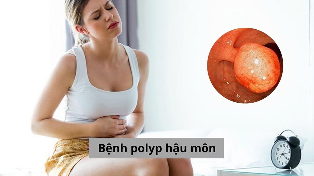 Bệnh polyp hậu môn