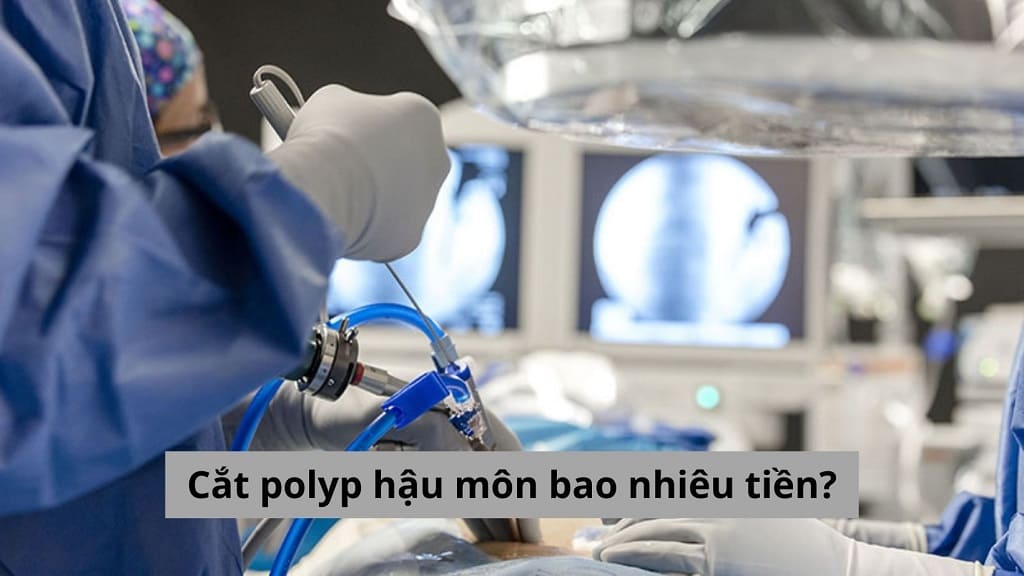 Cắt polyp hậu môn bao nhiêu tiền