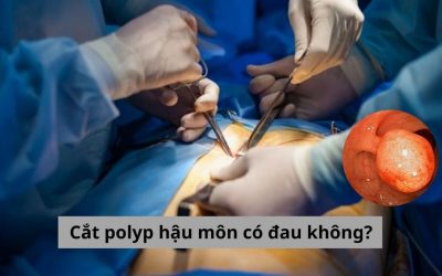 Cắt polyp hậu môn có đau không? Giải đáp thắc mắc chi tiết