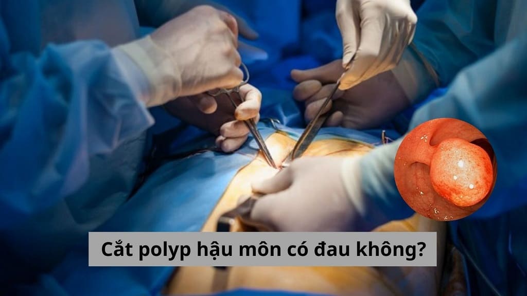 Cắt polyp hậu môn có đau không