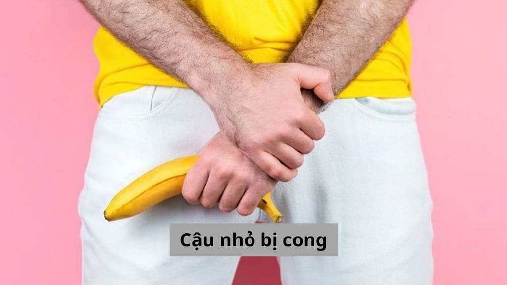 Cậu nhỏ bị cong