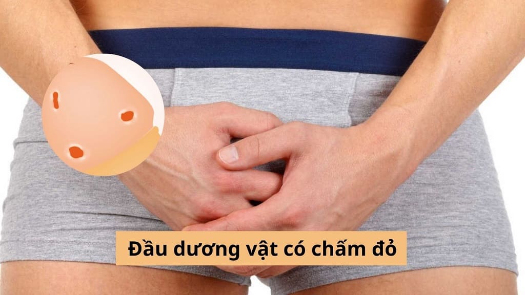 Đầu dương vật có chấm đỏ