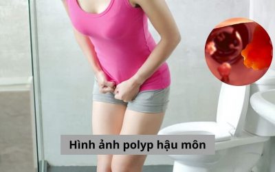 [Tổng hợp] Hình ảnh polyp hậu môn chi tiết và gợi ý cách điều trị