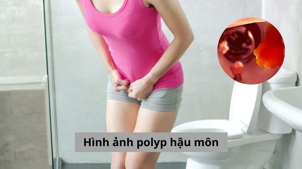 Hình ảnh polyp hậu môn