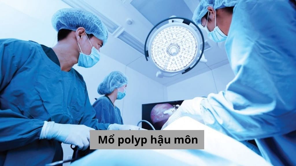 Mổ polyp hậu môn