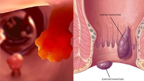 Phân biệt hình ảnh polyp hậu môn và trĩ