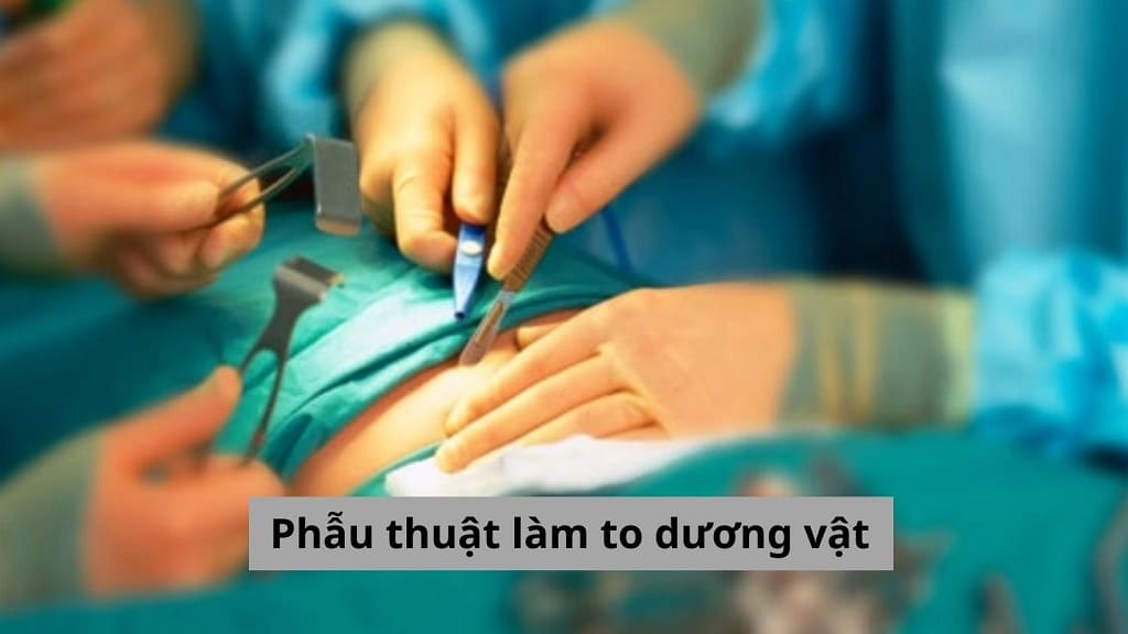 Phẫu thuật làm to dương vật