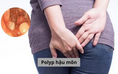 [Tổng hợp] Polyp hậu môn và những điều cần biết