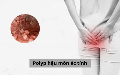 Polyp hậu môn ác tính: Tìm hiểu để bảo vệ sức khỏe