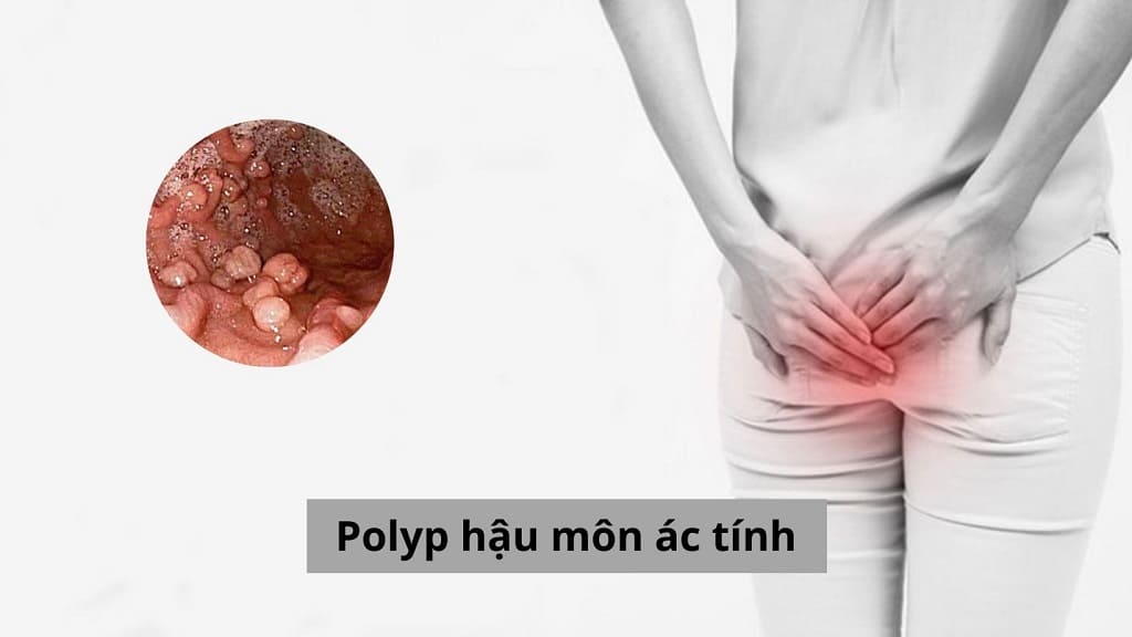 Polyp hậu môn ác tính