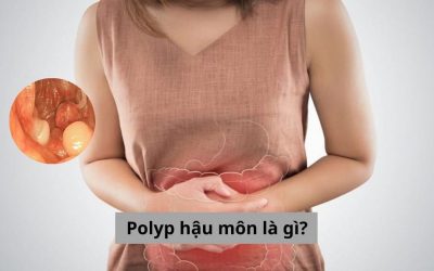 Polyp hậu môn là gì? Cùng chuyên gia giải đáp về các vấn đề liên quan