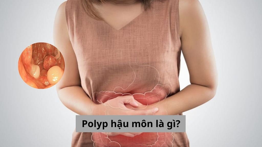 Polyp hậu môn là gì