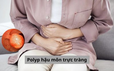 Cần biết những gì về bệnh polyp hậu môn trực tràng?