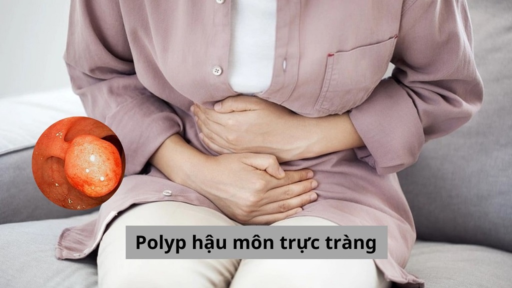 Polyp hậu môn trực tràng