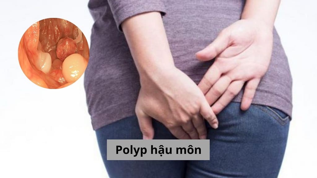 Polyp hậu môn