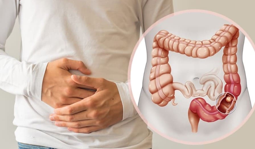 Polyp hậu môn trực tràng có phải là một bệnh lý nguy hiểm?