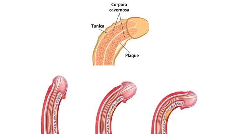 Nguyên nhân cậu nhỏ bị cong do đâu? 