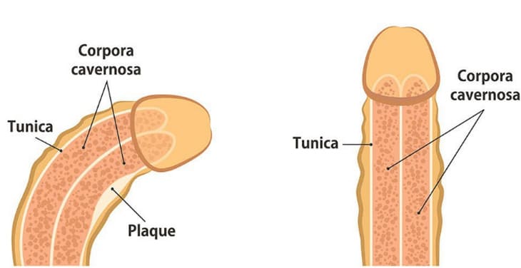 Vì nguyên nhân nào mà dương vật của nam giới bị cong?