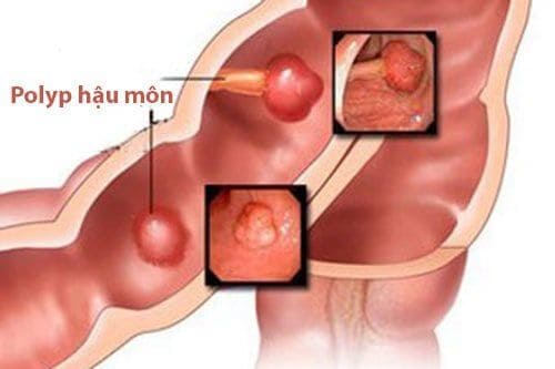 Hình ảnh polyp hậu môn