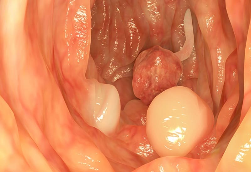 Polyp hậu môn và nguyên nhân gây bệnh