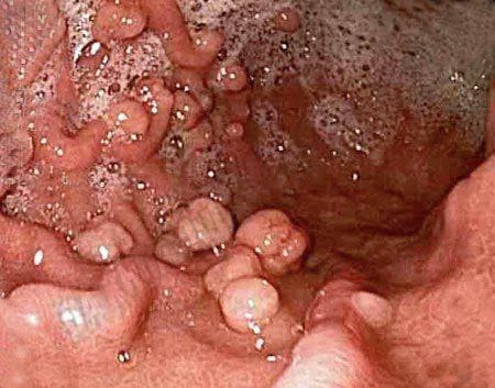 Nhận diện polyp hậu môn ác tính thông qua triệu chứng nào?