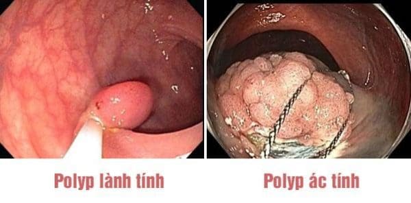 Nguyên nhân hình thành polyp hậu môn là vì đâu?