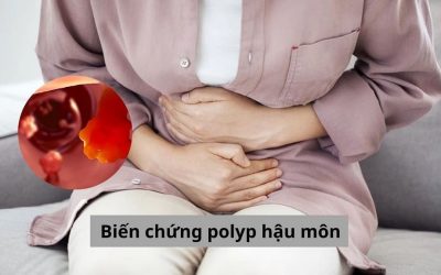 Những dấu hiệu cảnh báo nguy hiểm từ biến chứng polyp hậu môn