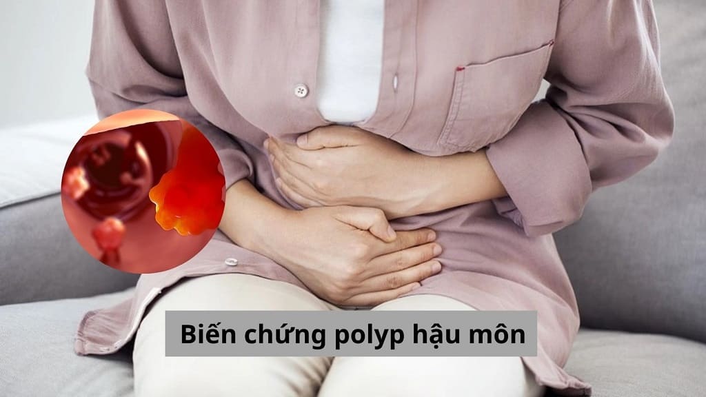 Biến chứng polyp hậu môn