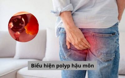 Nhận biết các biểu hiện polyp hậu môn điển hình