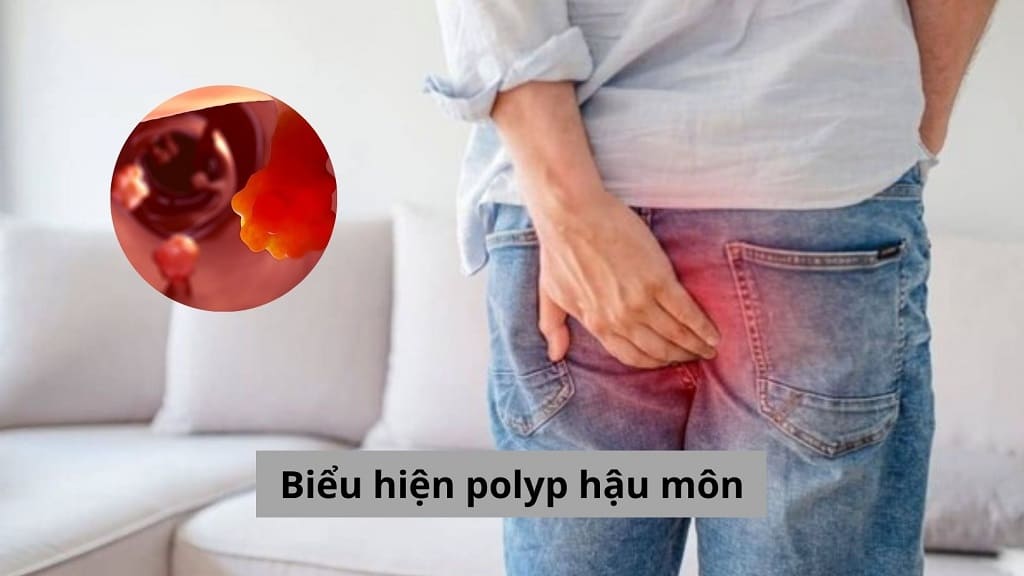 Biểu hiện polyp hậu môn