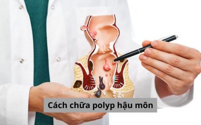 Cách chữa polyp hậu môn như thế nào vừa hiệu quả lại tiết kiệm? 