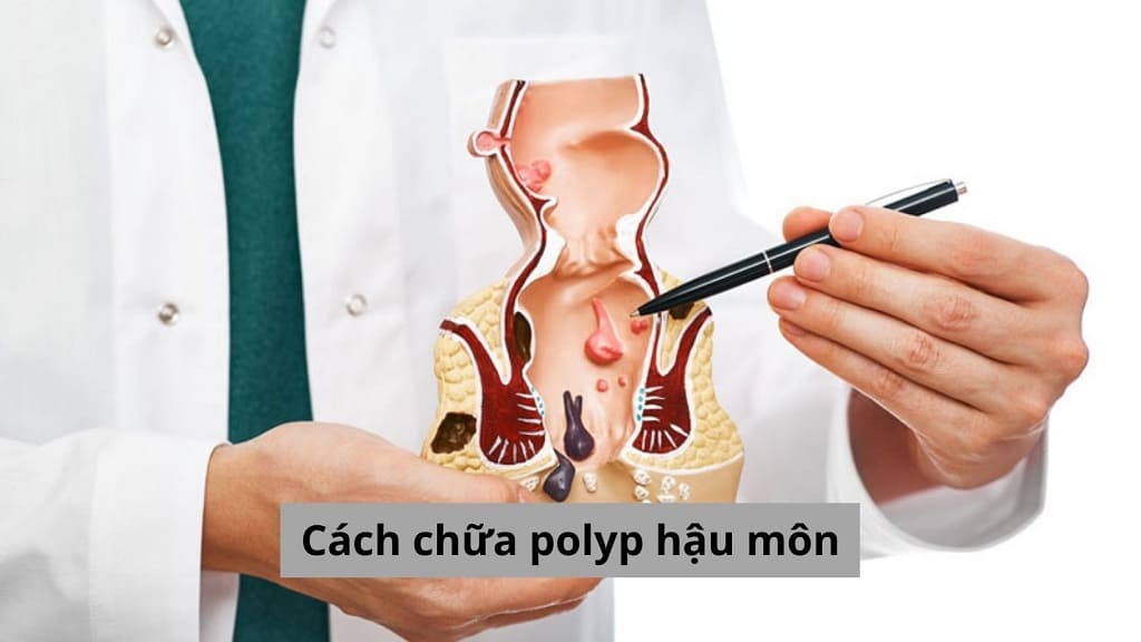 Cách chữa polyp hậu môn