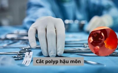 Cắt polyp hậu môn và những điều cần biết [Giải đáp]