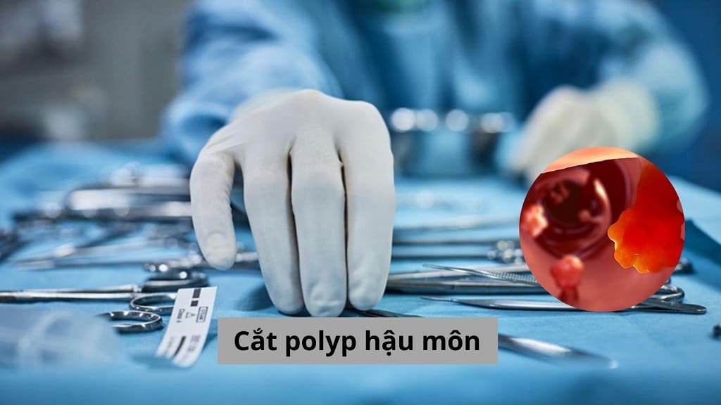 Cắt polyp hậu môn