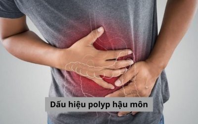 Dấu hiệu polyp hậu môn điển hình ai cũng cần nắm rõ