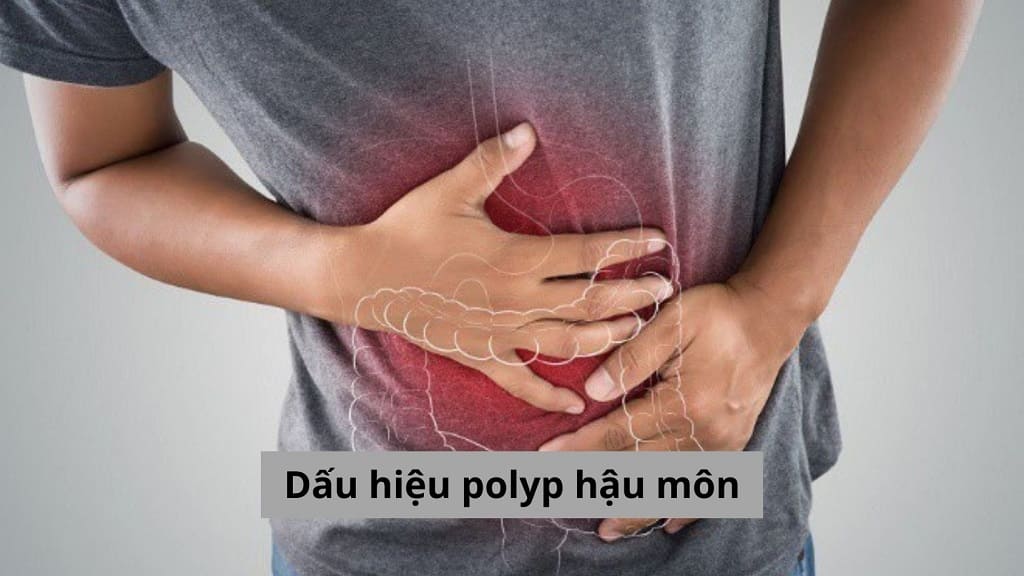 Dấu hiệu polyp hậu môn