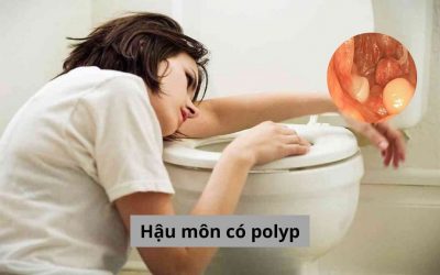 Giải đáp:b Hậu môn có polyp người bệnh cần phải làm gì?