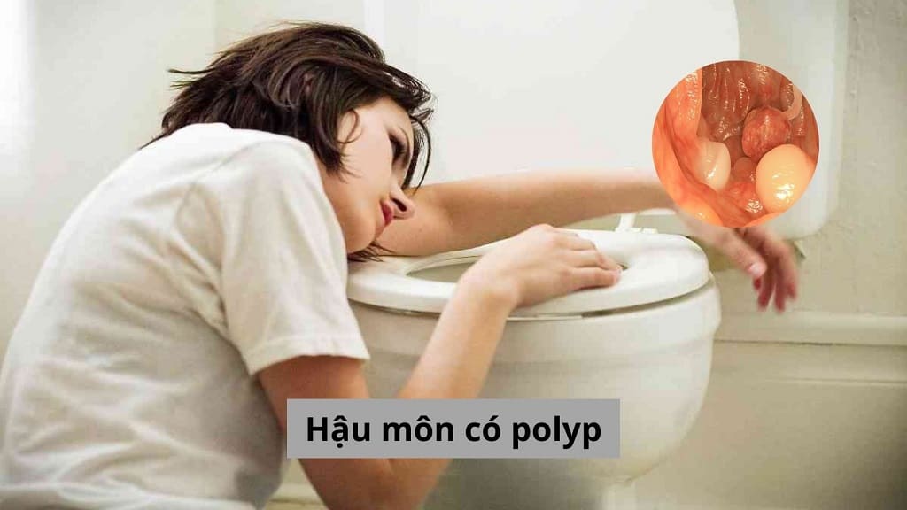 Hậu môn có polyp