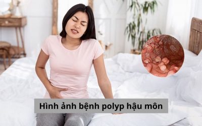 Hình ảnh bệnh polyp hậu môn: Cảnh báo sớm cho sức khỏe của bạn