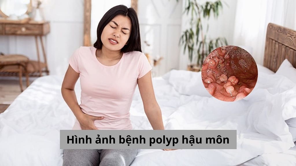 Hình ảnh bệnh polyp hậu môn