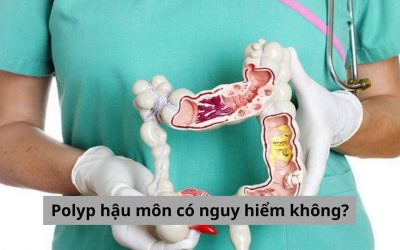 Polyp hậu môn có nguy hiểm không và cách điều trị hiệu quả 