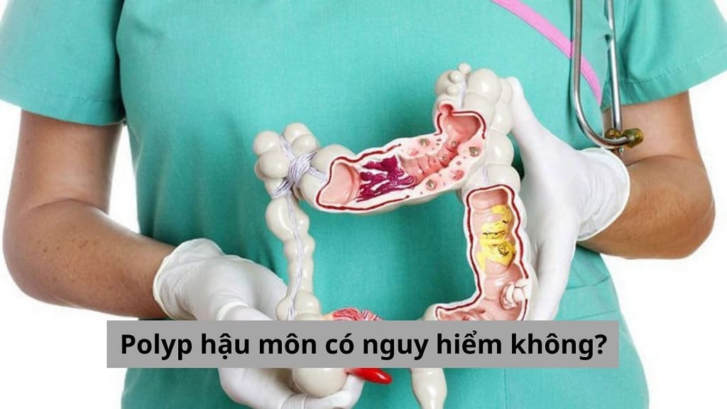 Polyp hậu môn có nguy hiểm không