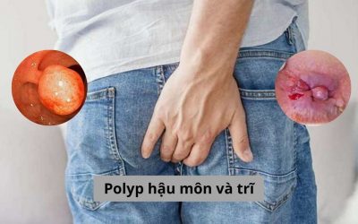 Phân biệt polyp hậu môn và trĩ – Bác sĩ chuyên khoa chia sẻ cách điều trị