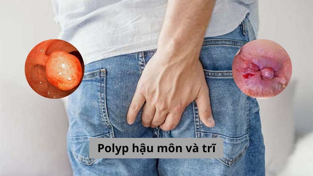 Polyp hậu môn và trĩ