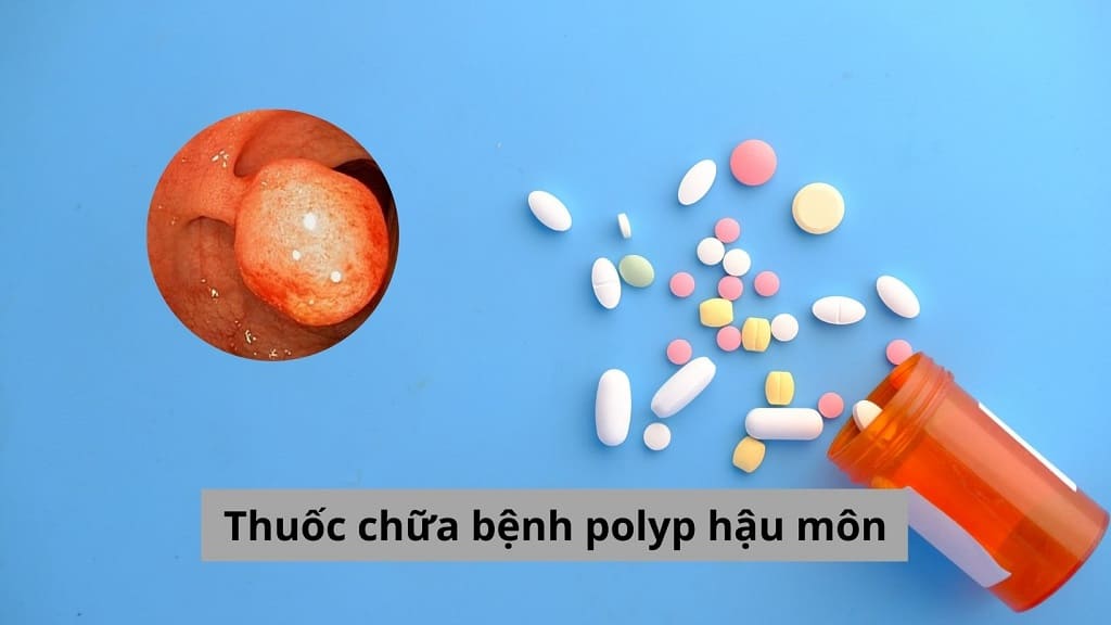 Thuốc chữa bệnh polyp hậu môn