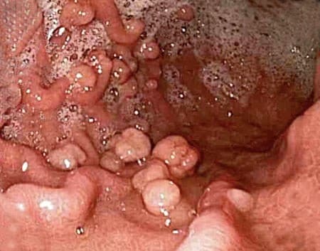 Biến chứng polyp hậu môn nguy hiểm