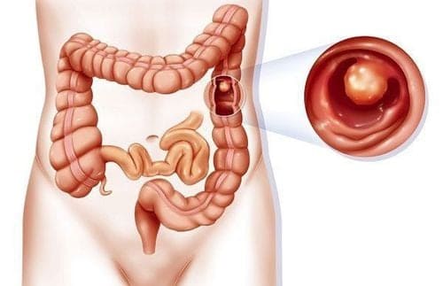 Bệnh lý polyp hậu môn